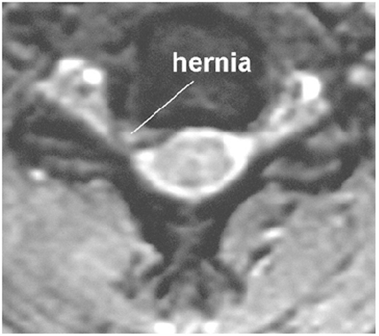 MRI van een nekhernia