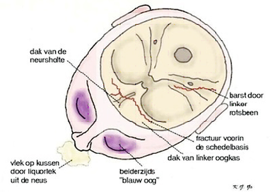 schedelbasisfracturen
